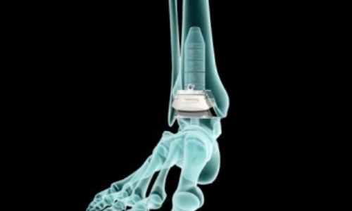 Ayak bileği protezi kimlere uygulanır?