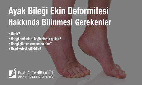 Ayak Bileği Ekin Deformitesi Hakkında Bilinmesi Gerekenler