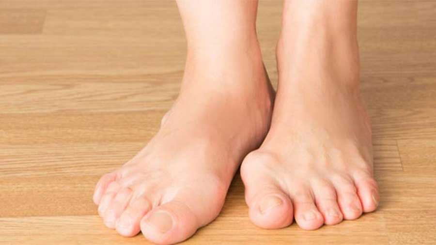 halluks valgus