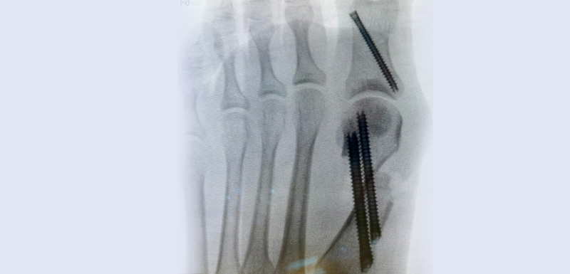 MİNİMAL İNVAZİV (KAPALI) HALLUKS VALGUS CERRAHİSİ