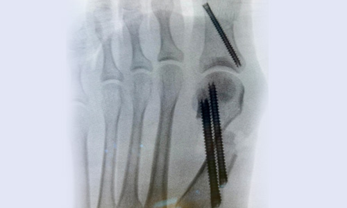 MİNİMAL İNVAZİV (KAPALI) HALLUKS VALGUS CERRAHİSİ