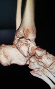 Tarsal koalisyon nedir